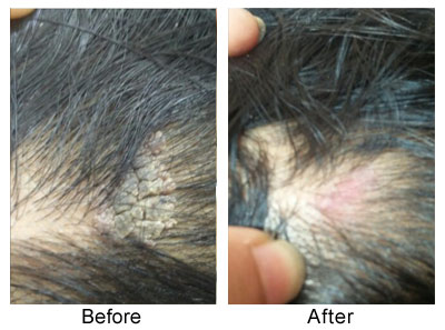 Alopecia Areata