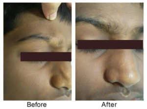 Eyebrow Lesion